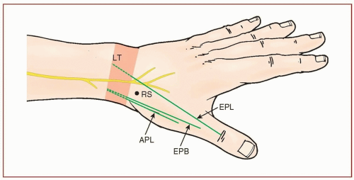 First Dorsal Extensor Compartment Release | Musculoskeletal Key