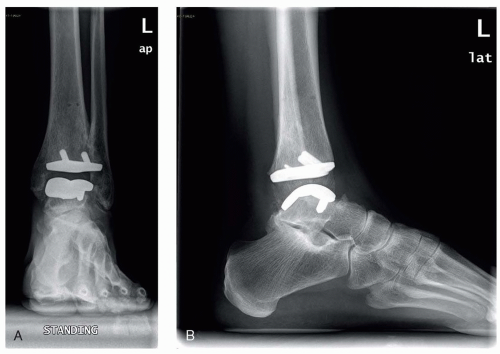 Transtibial Amputation | Musculoskeletal Key