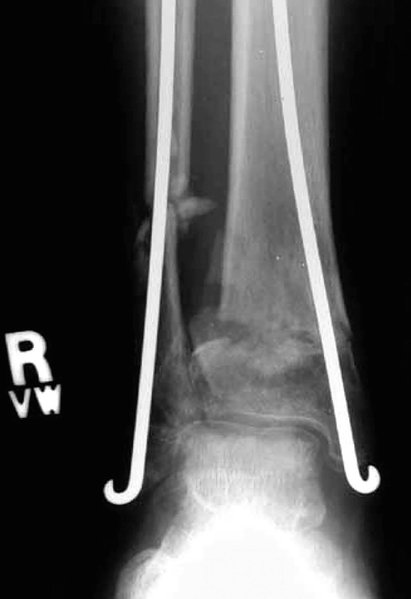 Of The Ankle And Foot | Musculoskeletal Key