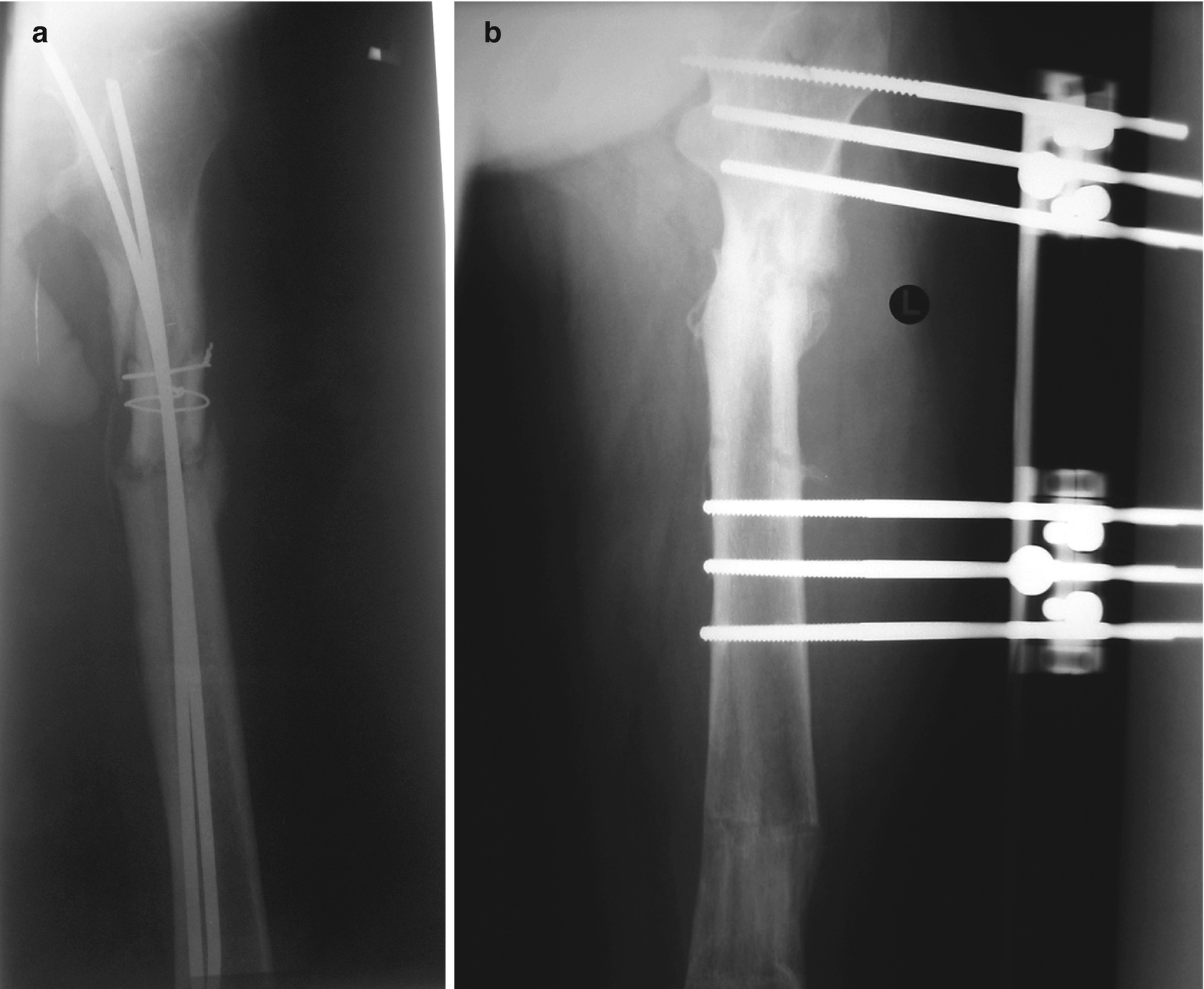 And Septic Arthritis In Adults | Musculoskeletal Key