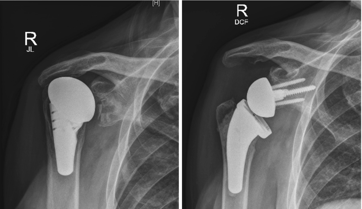 Total Shoulder Arthroplasty: Epidemiology And Causes | Musculoskeletal Key