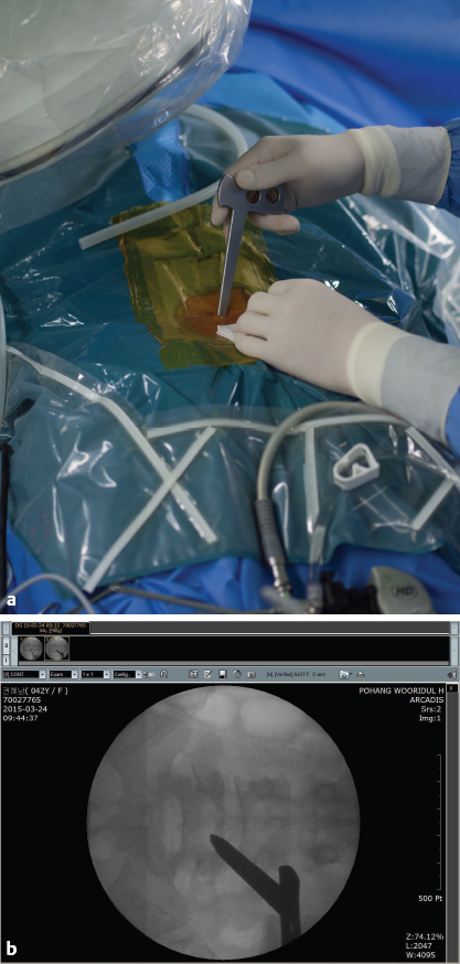 Unilateral Biportal Endoscopic Decompression For Lumbar Spinal Stenosis ...