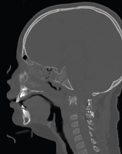 Endoscopic Transnasal Approaches To The Craniocervical Junction ...