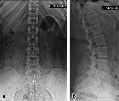 Anterior Lumbar Interbody Fusion | Musculoskeletal Key