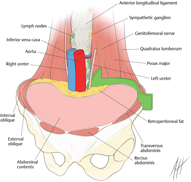 Lateral Lumbar Interbody Fusion Musculoskeletal Key