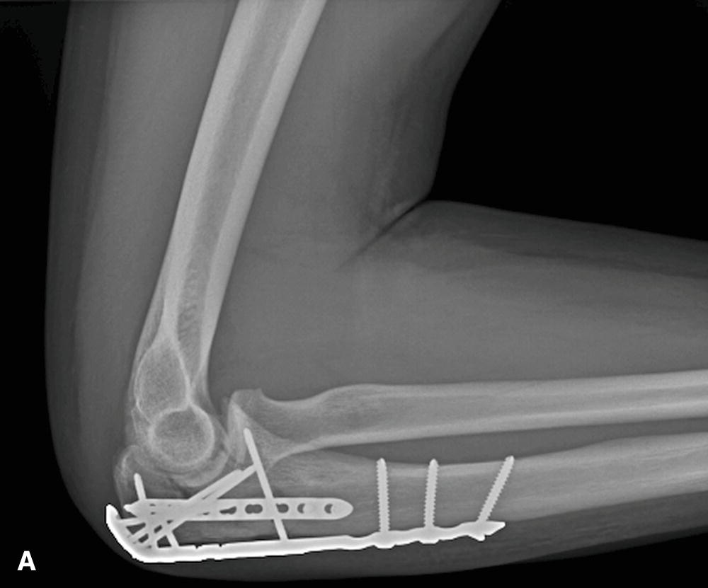 Olecranon Fractures | Musculoskeletal Key