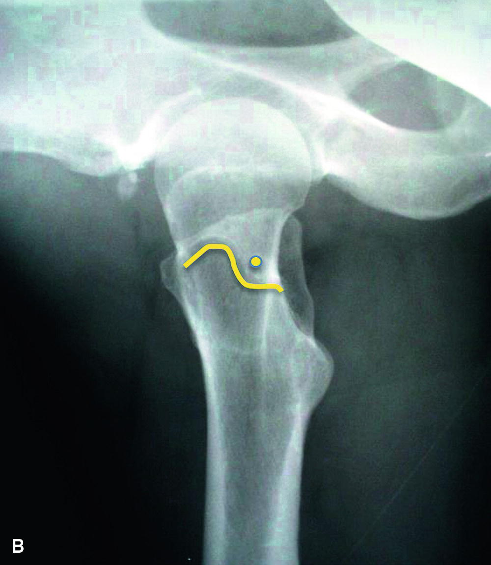 Femoral Shaft Imaging | Musculoskeletal Key