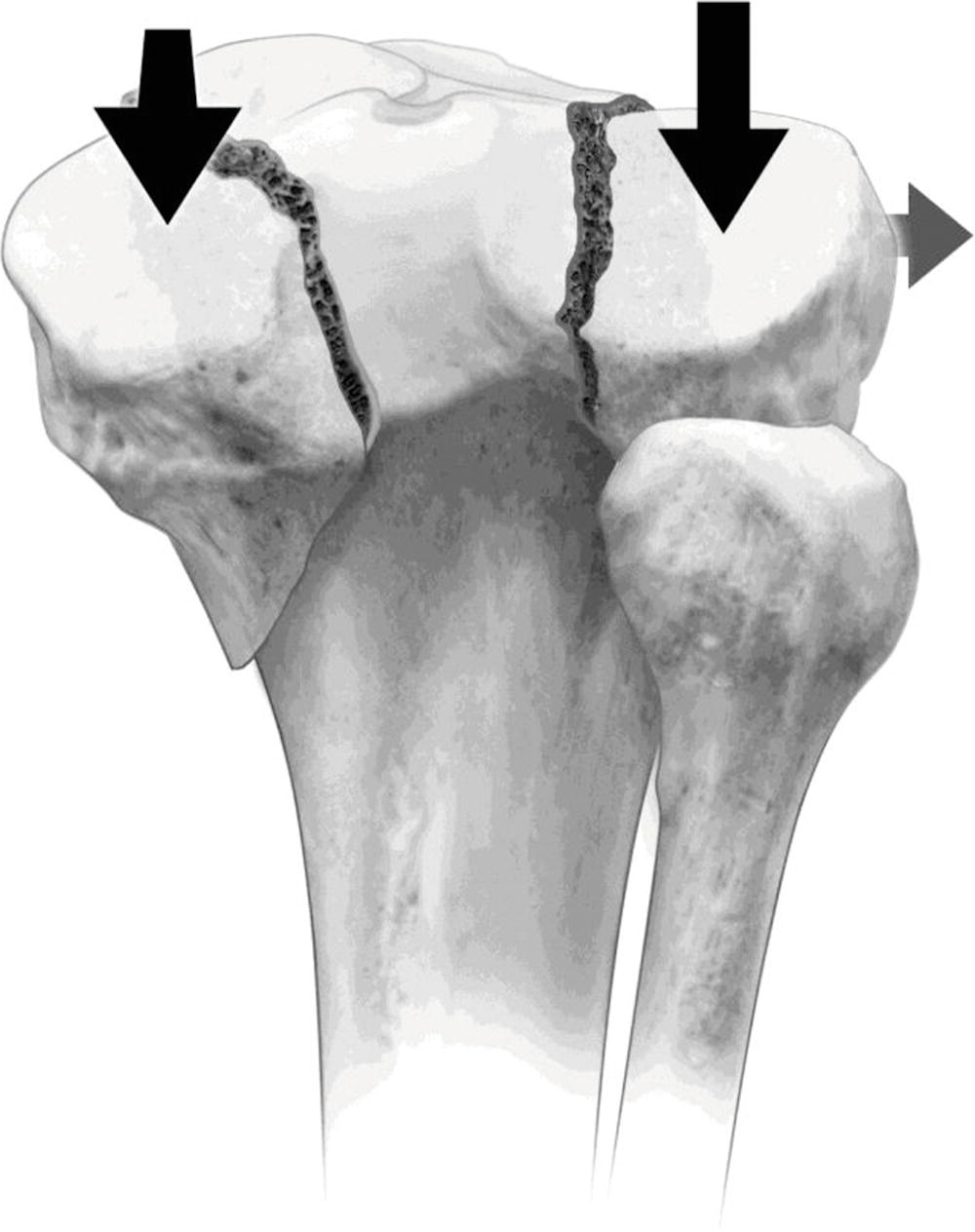 Tibial Plateau Fractures | Musculoskeletal Key