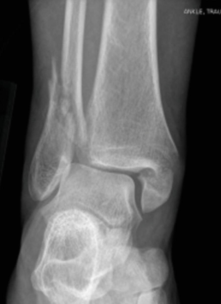 Ankle/Pilon Fractures | Musculoskeletal Key