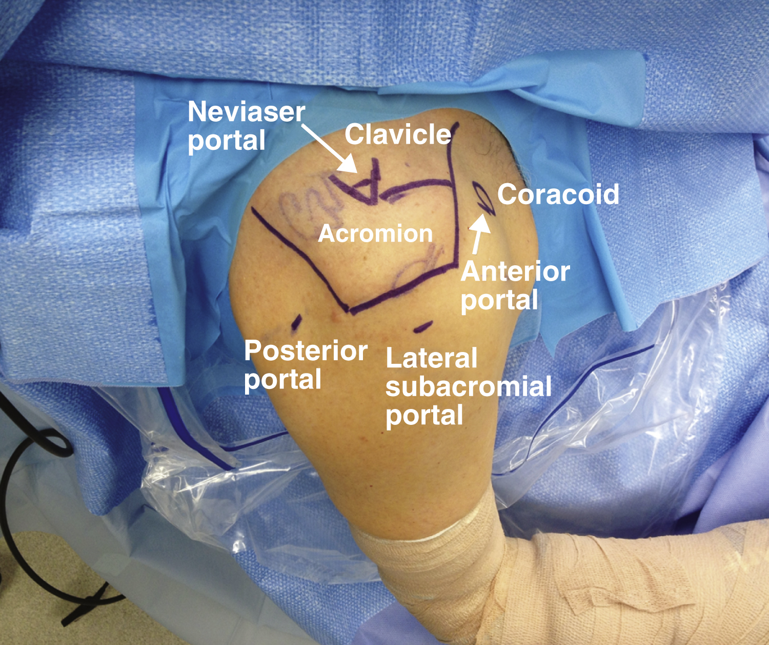 Arthroscopic Anatomy Of The Shoulder And Cuff | Musculoskeletal Key