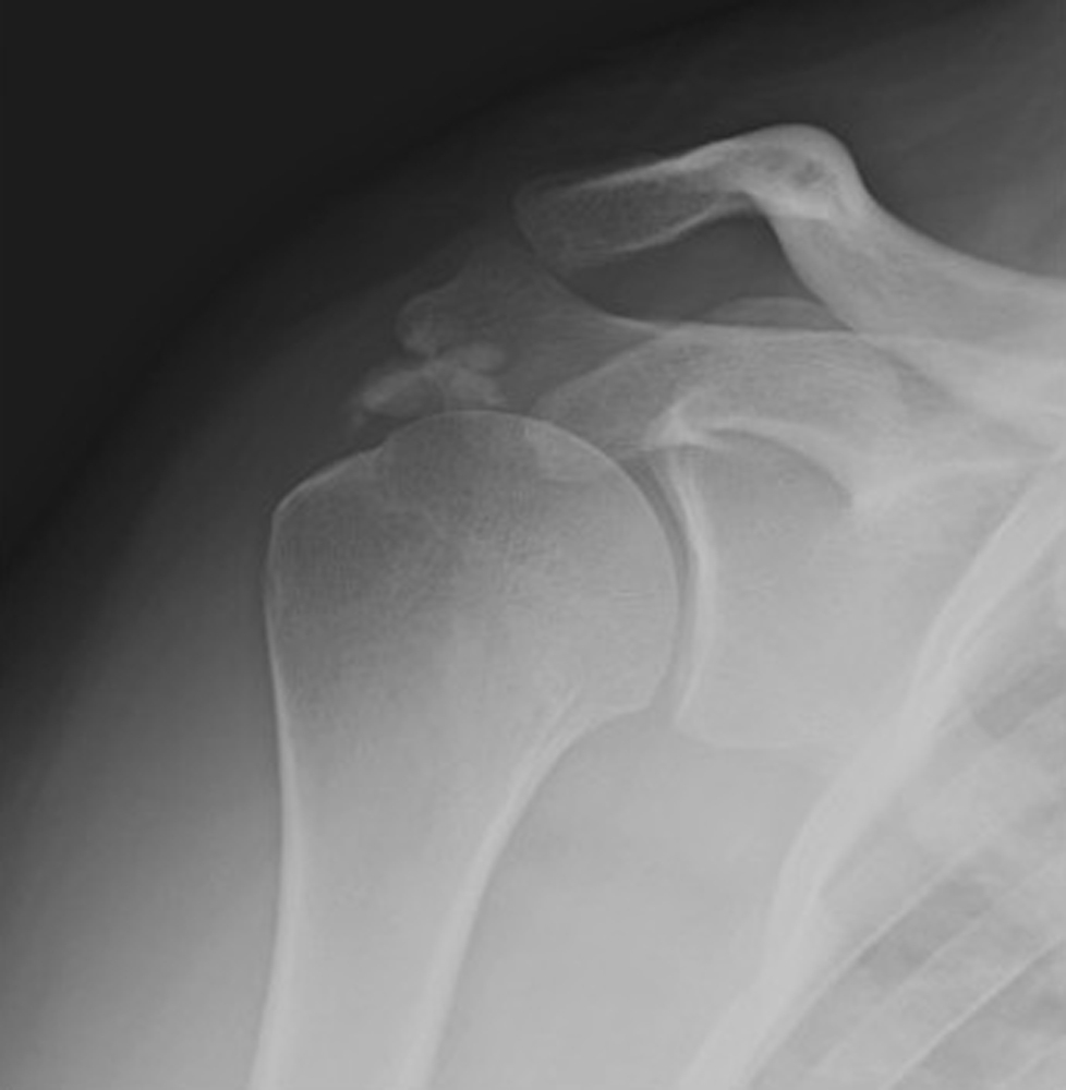 Imaging For Rotator Cuff Pathology | Musculoskeletal Key