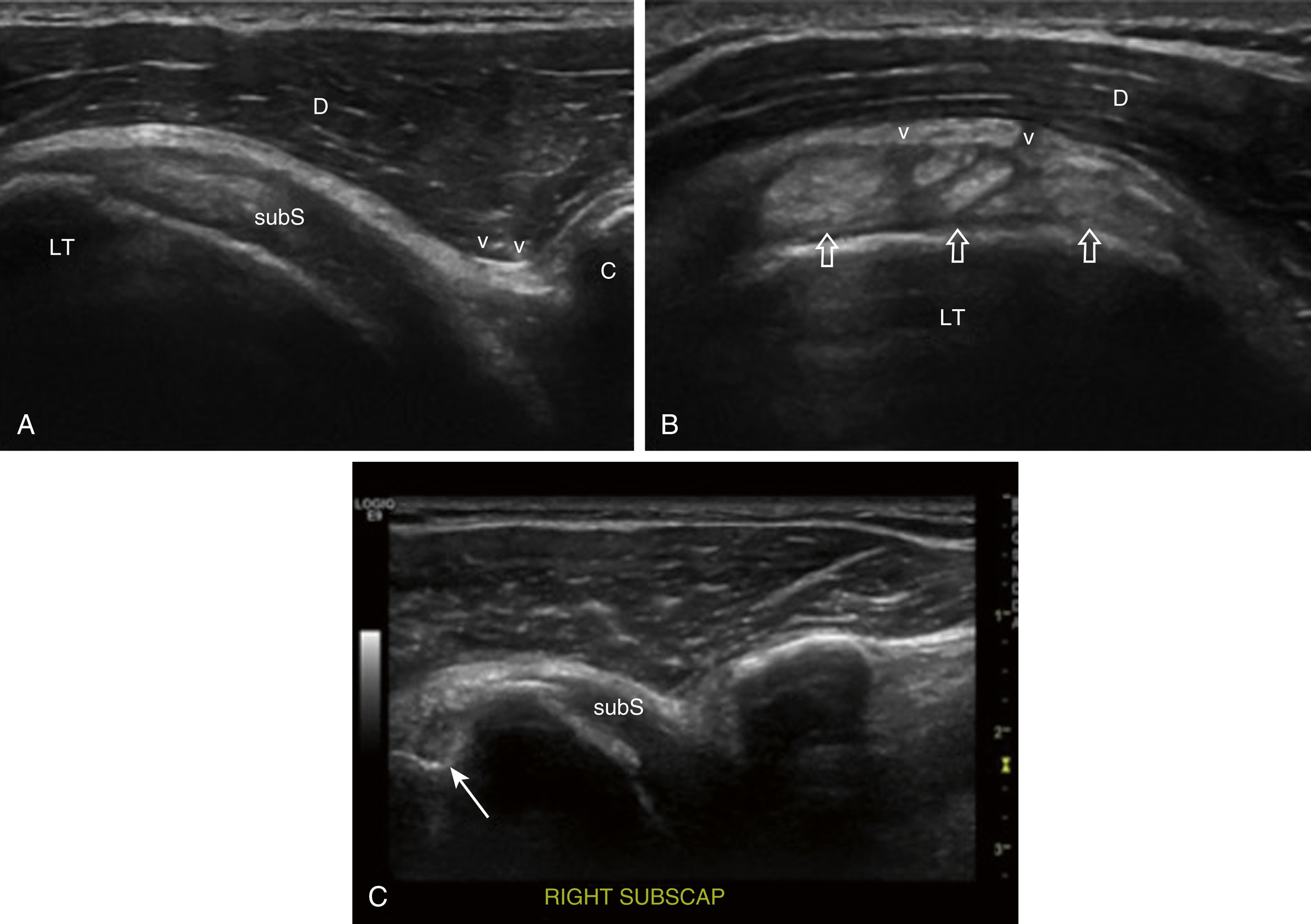 Imaging For Rotator Cuff Pathology | Musculoskeletal Key