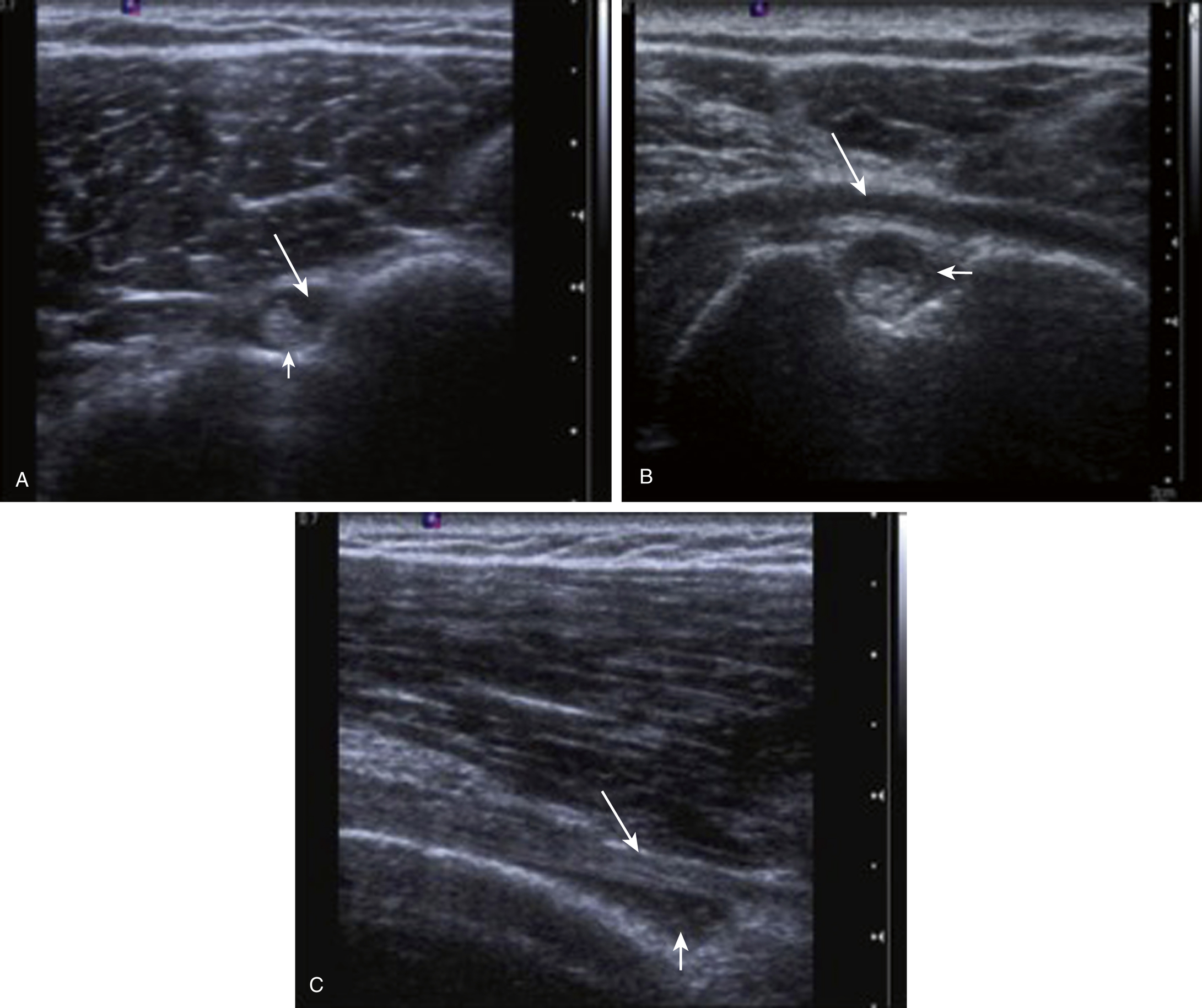 Imaging For Rotator Cuff Pathology | Musculoskeletal Key