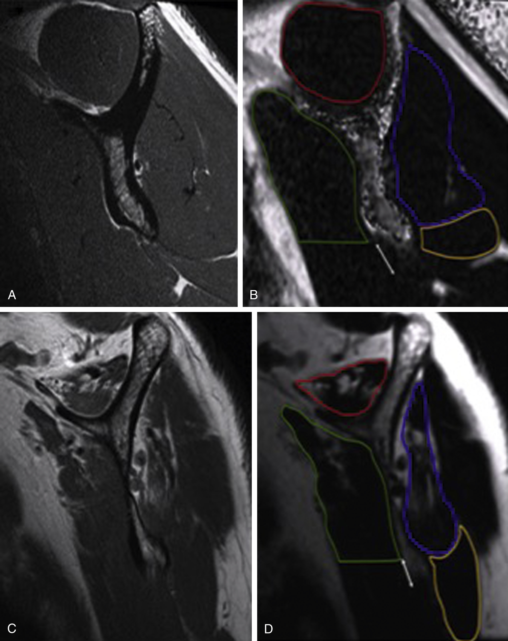 Imaging For Rotator Cuff Pathology | Musculoskeletal Key