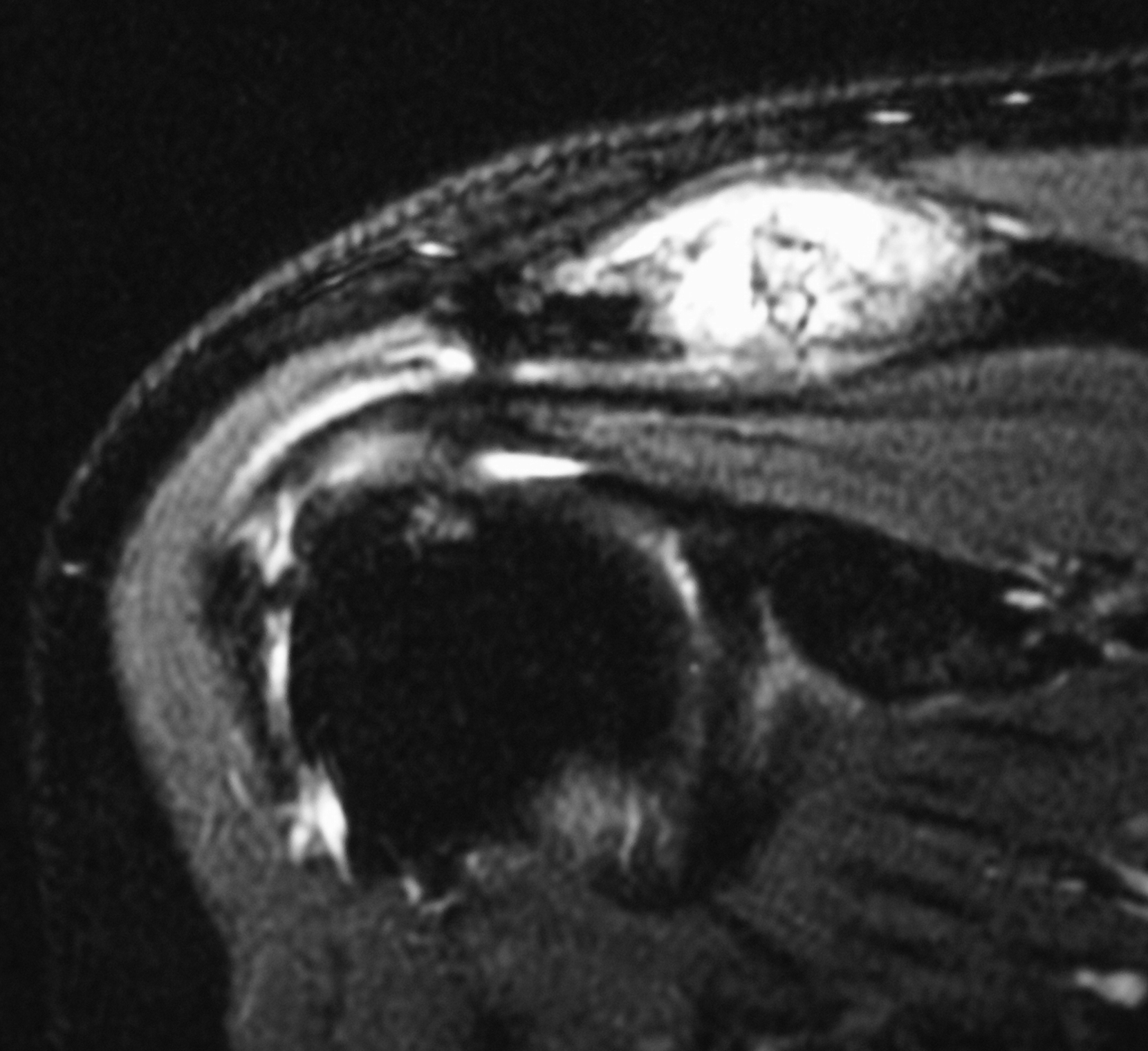 Shoulder Subacromial Impingement Syndrome Synergy