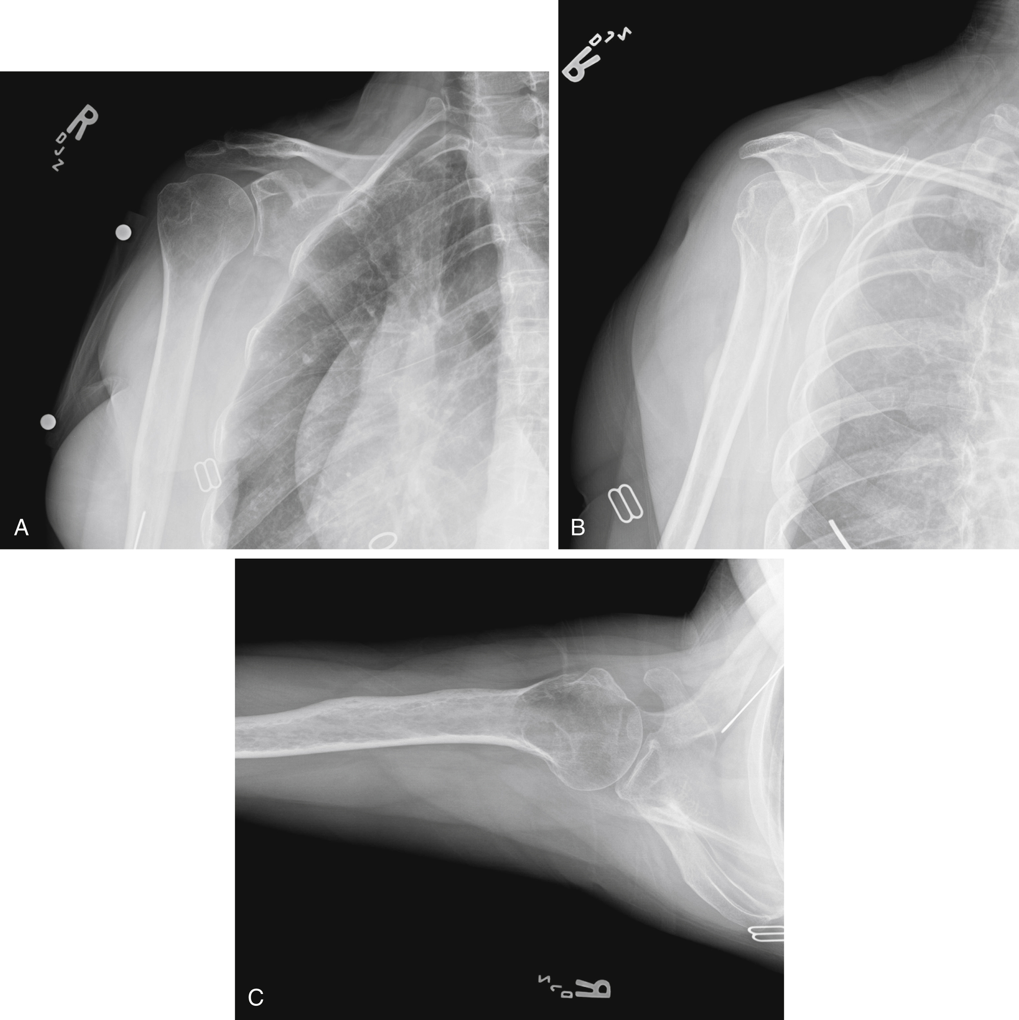 Calcific Tendinopathy | Musculoskeletal Key