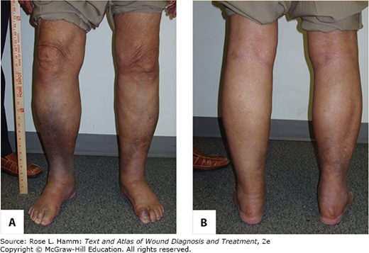 Lymphedema | Musculoskeletal Key