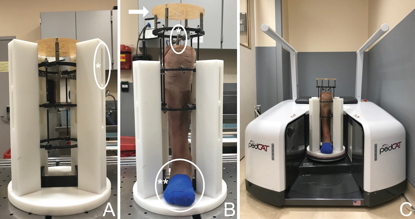 Of Weight Bearing Computed Tomography In Subtalar Joint Instability: A ...