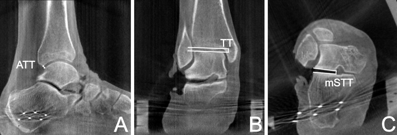 Of Weight Bearing Computed Tomography In Subtalar Joint Instability: A ...