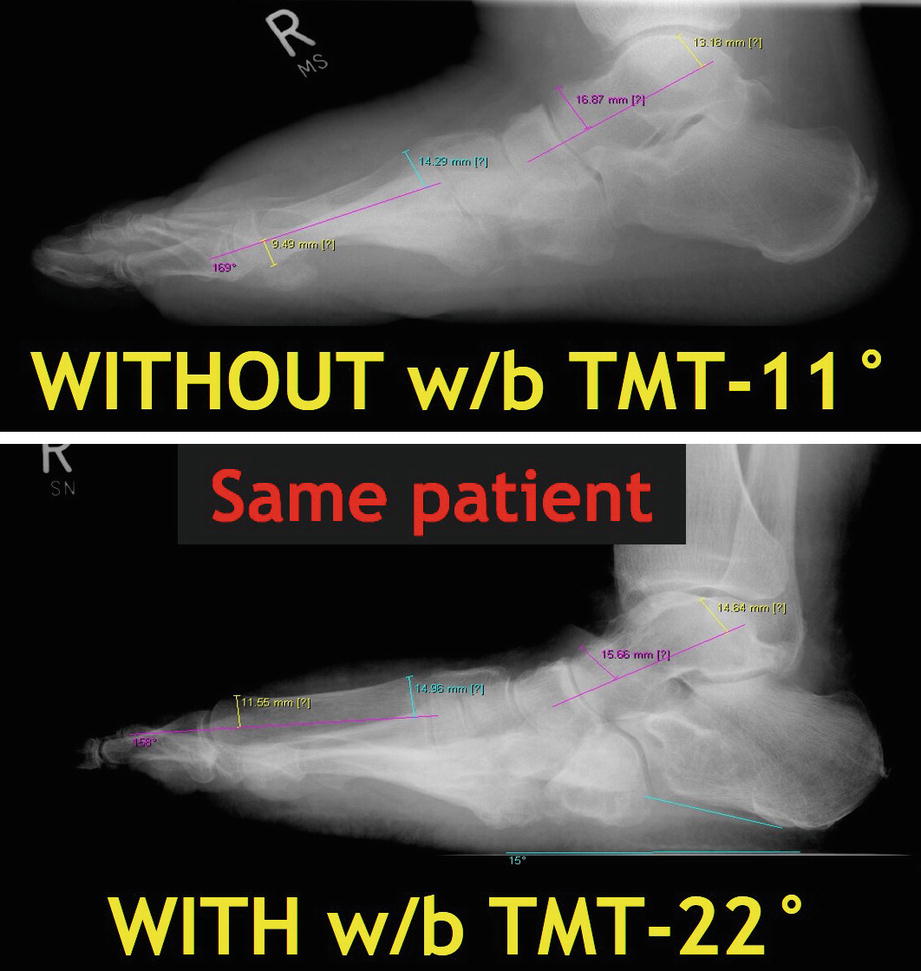 Of Weight Bearing Cone Beam Computed Tomography | Musculoskeletal Key