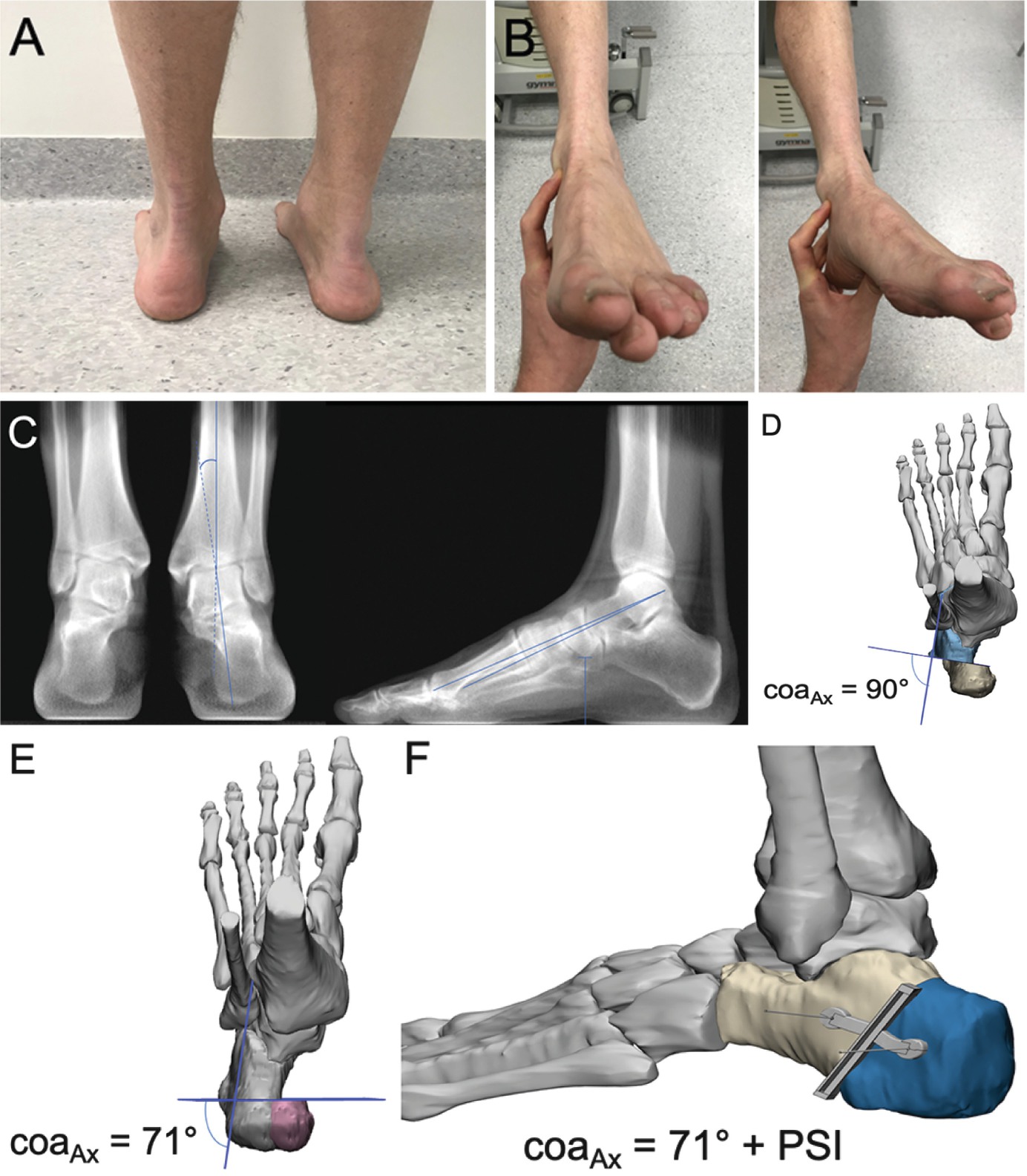 Examples Of Weight Bearing Computed Tomography | Musculoskeletal Key