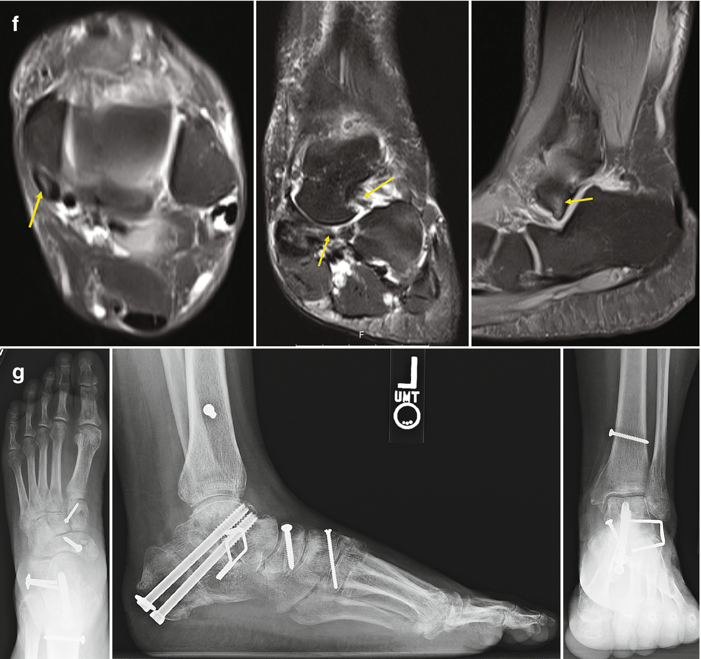 Examples Of Weight Bearing Computed Tomography | Musculoskeletal Key