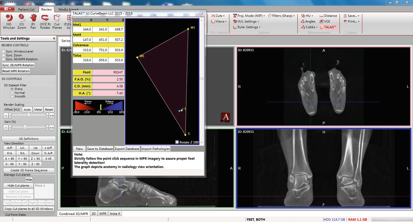 Biometrics For Hindfoot Alignment Using Weight Bearing Computed ...