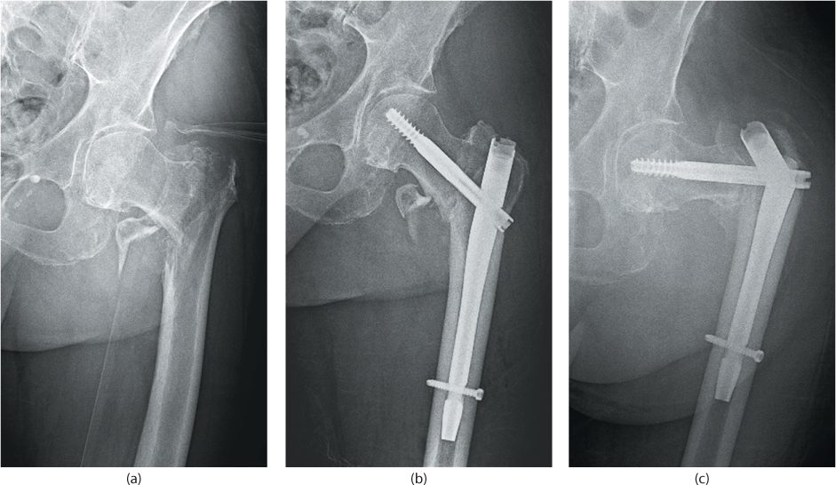 Extracapsular Proximal Femur Fractures | Musculoskeletal Key