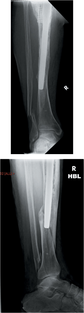 Tibia And Fibula Diaphyseal Fractures | Musculoskeletal Key