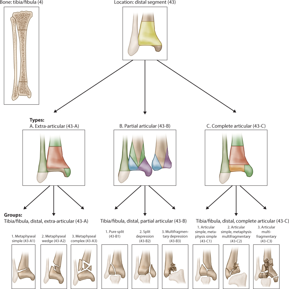 Distal Tibial Fractures | Musculoskeletal Key