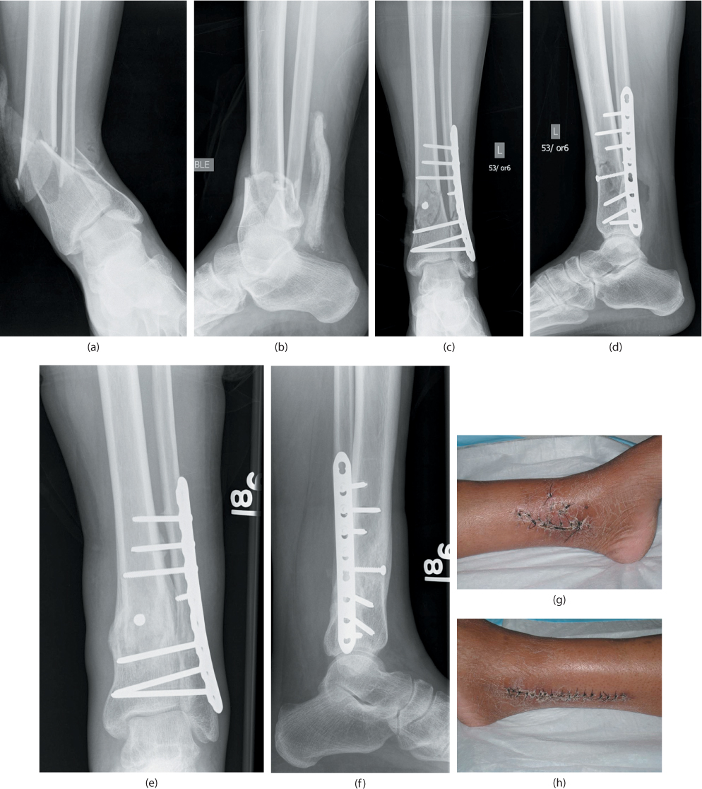 Distal Tibial Fractures | Musculoskeletal Key