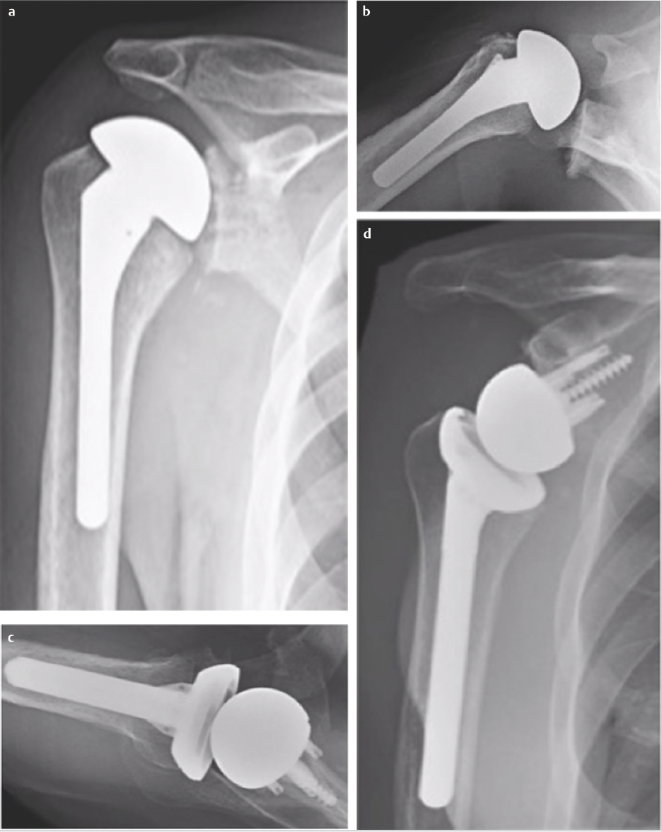 Chapter 15 Reverse Shoulder Arthroplasty In Revision Shoulder ...