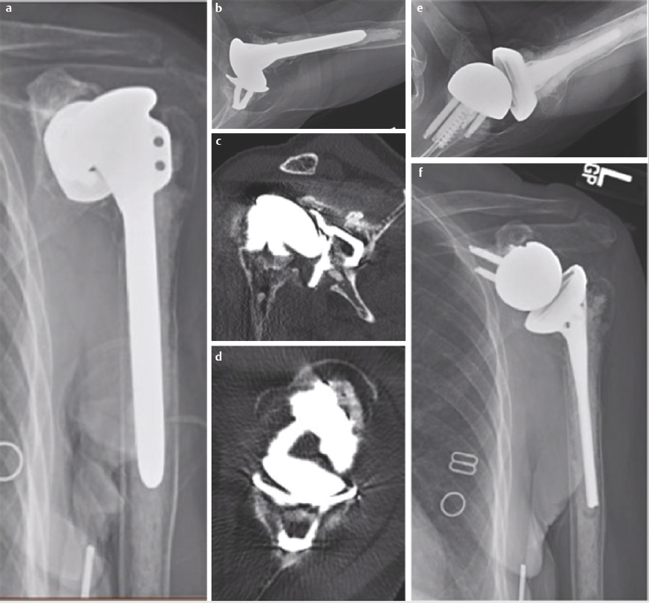 Chapter 15 Reverse Shoulder Arthroplasty In Revision Shoulder ...