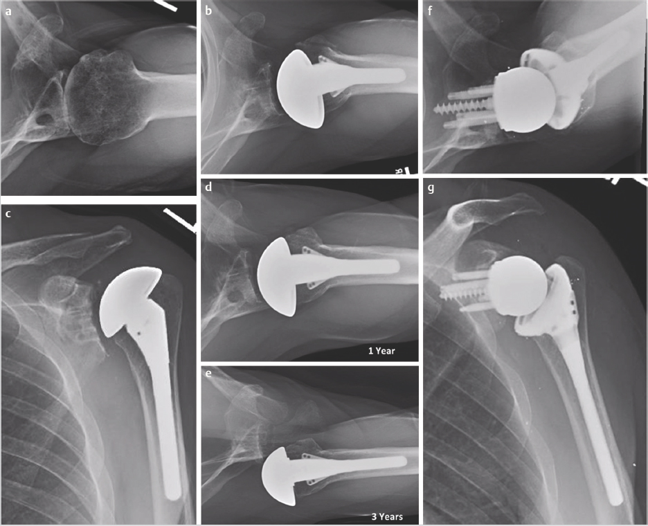 Chapter 15 Reverse Shoulder Arthroplasty In Revision Shoulder ...