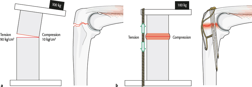 3.2.3 Tension Band Principle | Musculoskeletal Key