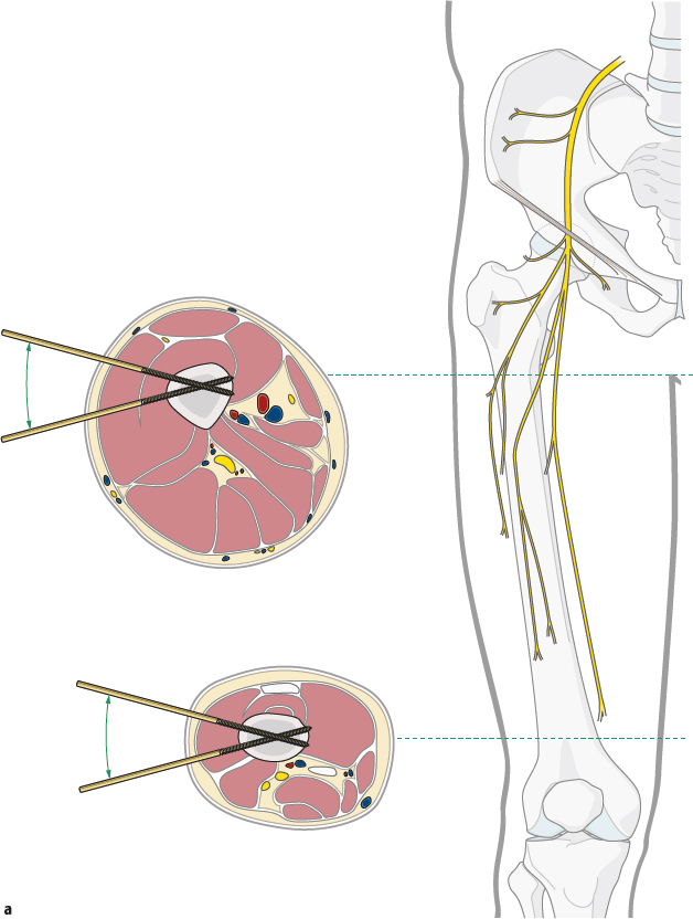 3.3.3 External Fixator | Musculoskeletal Key