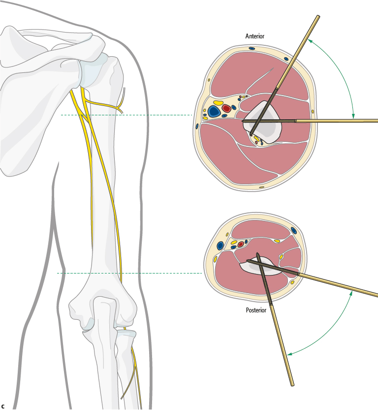 3.3.3 External Fixator | Musculoskeletal Key