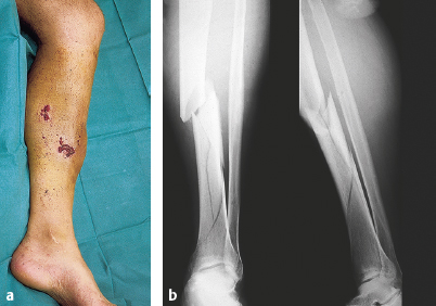 Open Tibia Fracture