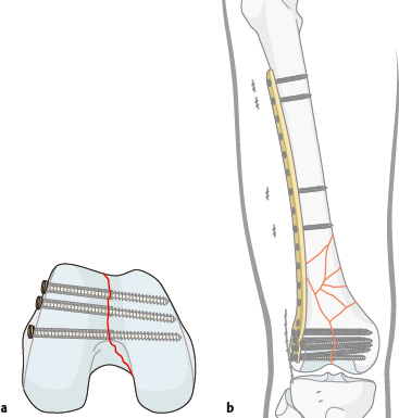 6.6.3 Femur, Distal | Musculoskeletal Key