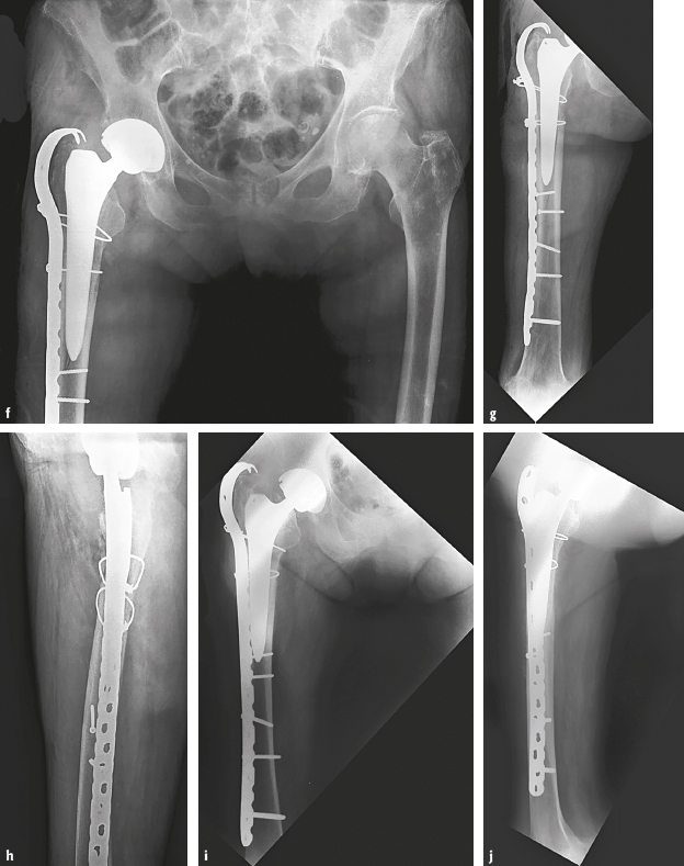 6.6.4 Periprosthetic Fractures | Musculoskeletal Key