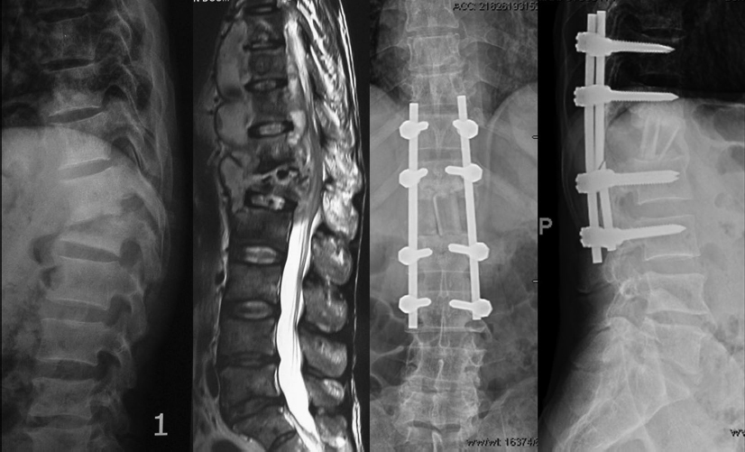 14 Human Immunodeficiency Virus And Spinal Infections | Musculoskeletal Key