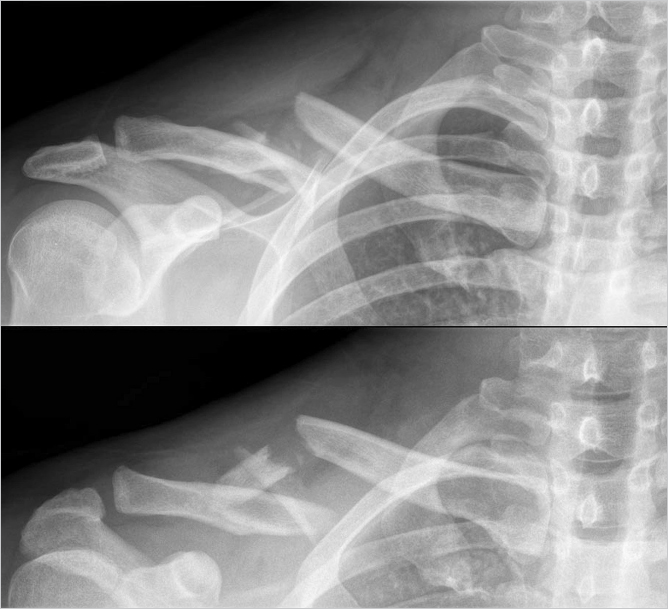 68 Open Reduction And Internal Fixation Of Midshaft Clavicle Fracture ...