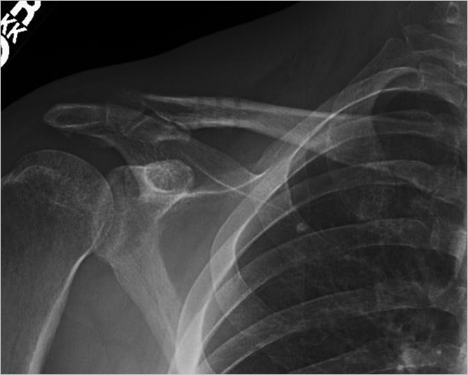 69 Open Reduction And Internal Fixation Of Distal Clavicle Fractures ...