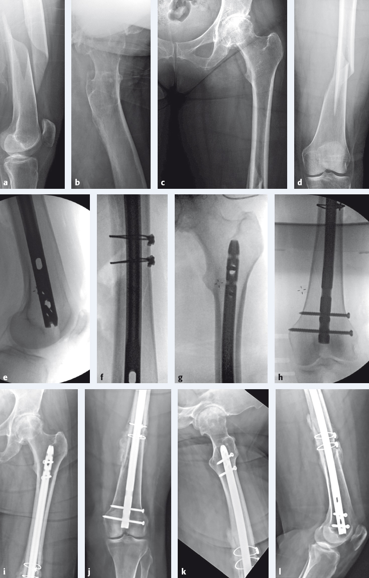 3.11 Femoral Shaft | Musculoskeletal Key