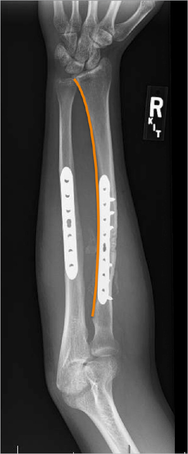 6 Both Bone Forearm Fracture | Musculoskeletal Key