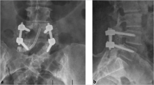 22 Posterior Lumbar Laminectomy And Pedicle Screw Instrumentation ...