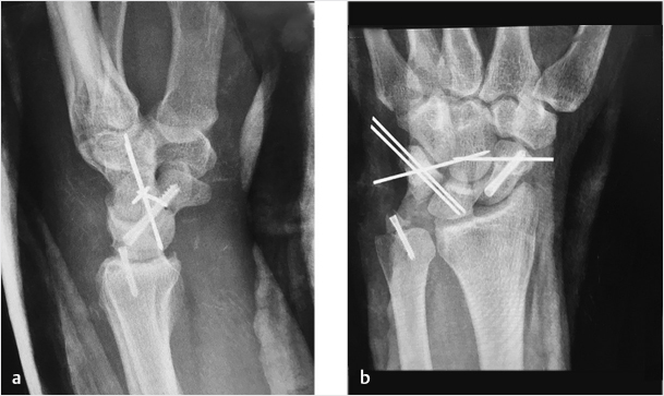 18 Distal Ulna Fractures | Musculoskeletal Key