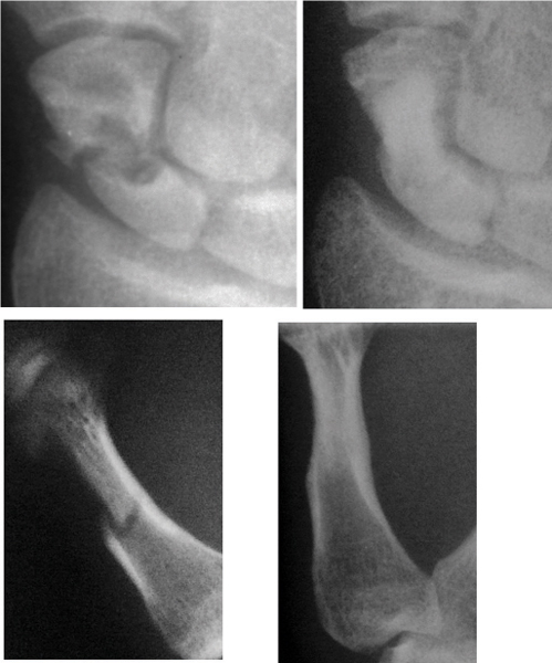 Thumb Metacarpal Vascularized Bone Grafts For Scaphoid Nonunion ...