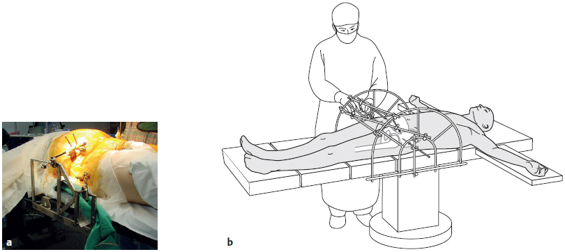 1.8.5 Internal Fixation Of Lateral Compression Fractures (type B2 ...