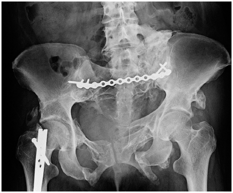 1.8.6 Internal Fixation Of Unstable Fractures (types B3 And C ...